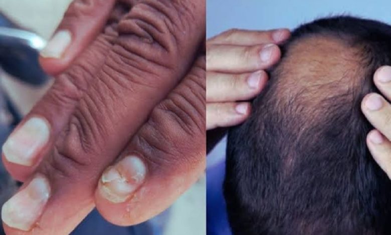 After baldness, now his nails are damaged! New panic in Buldhana, Maharashtra