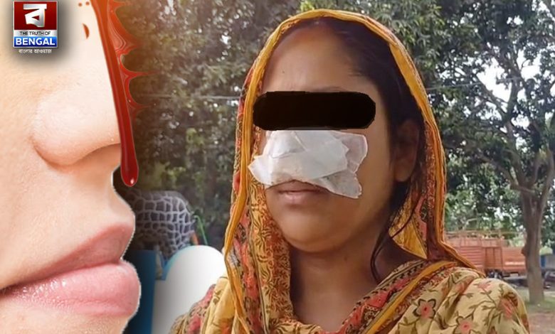 Husband bites wife's nose! Strange incident witnessed in Shantipur