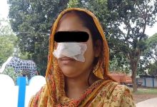 Husband bites wife's nose! Strange incident witnessed in Shantipur
