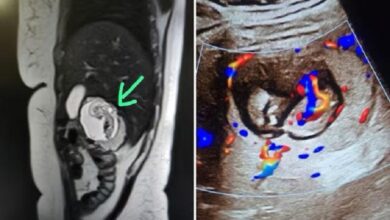 India’s first intrahepatic ectopic gestation with a 12‑week foetus growing in the liver, posing extreme medical risk.