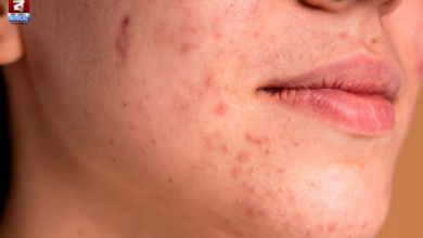 chin acne